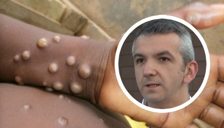 Liječnik objasnio kako se šire majmunske boginje i koji su simptomi