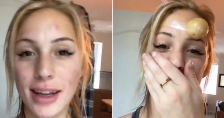 TikTokeri na lice stavljaju krumpir, evo što o tome misle dermatolozi