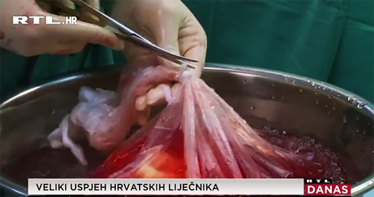 U KBC-u Zagreb prva transplantacija pluća nakon 10 godina, donator ubijeni Splićanin