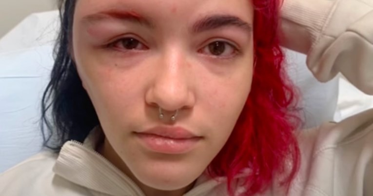 Tiktokerici se glava umalo udvostručila od alergijske reakcije na boju za kosu