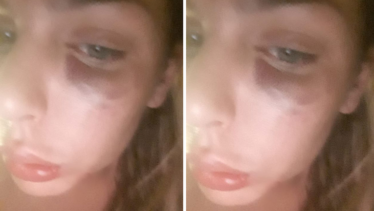 "Moje krvavo Valentinovo": Ava šokirala fanove snimkom deformiranog lica