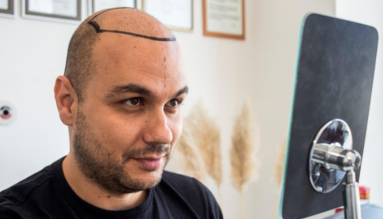 Svjetski poznata klinika za transplantaciju kose otvorila svoja vrata i u Sarajevu