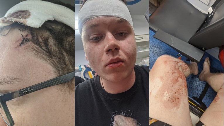 Student: Radnik aquaparka u Umagu me udario veslom po glavi, šikljala je krv