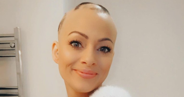 Žena nakon ugradnje kontracepcijske spirale ostala bez kose