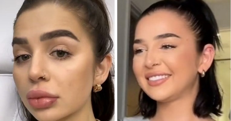 Žena postala ovisna o filerima, nakon 10 injekcija nije više osjećala lice