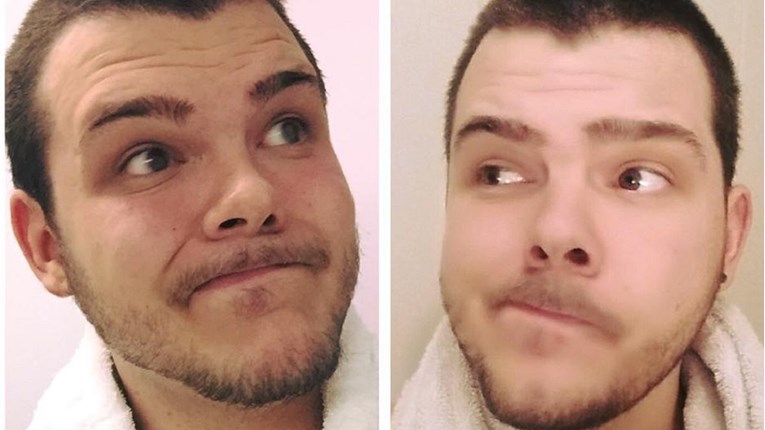 Smršavio je 30 kilograma da bi bratu blizancu donirao bubreg