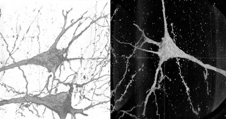 Rendgenske zrake pokazale da ljudi sa shizofrenijom imaju drugačije neurone