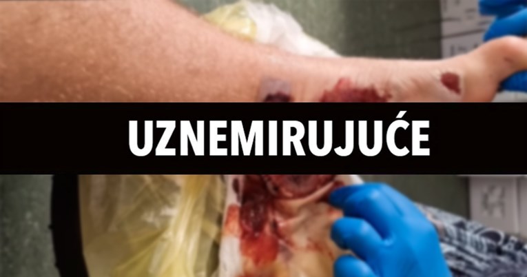 Srpski borac ovog vikenda je slavio u UFC-u. Evo kako mu je noga izgledala u srpnju