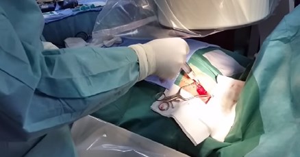 Muškarac u Indiji uhićen zbog optužbe da je supruzi ukrao bubreg
