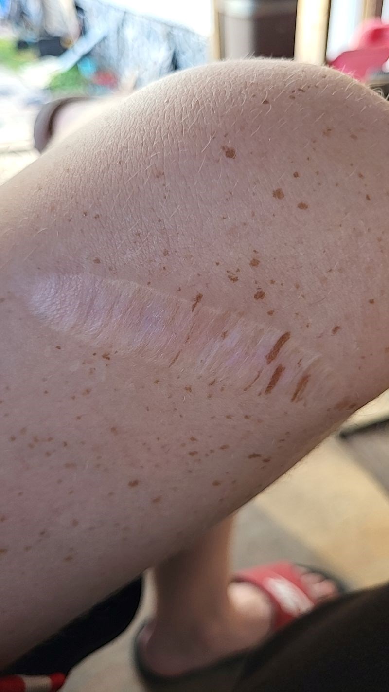 11. “Razvučene pjege na staroj posjekotini.”