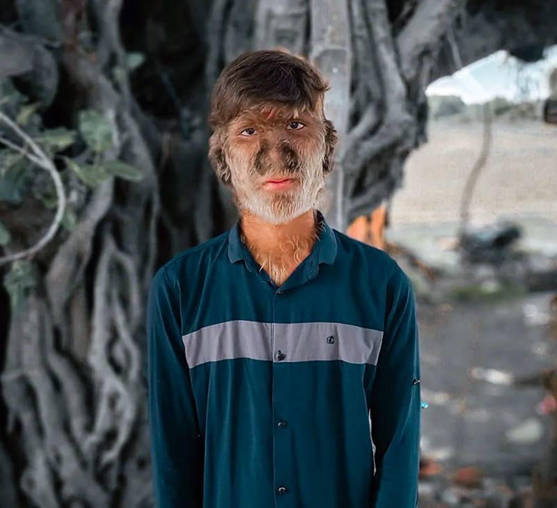 Tinejdžer iz Indije ima rijetko stanje koje se zove "sindrom vukodlaka", ili također poznato kao hipertrihoza