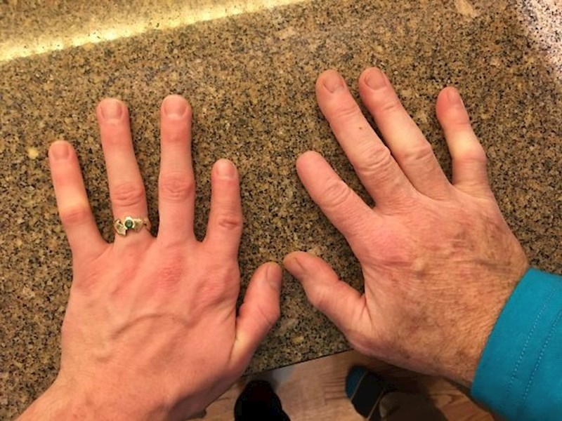 Mom tati su odrezali vrh kažiprsta kad je imao 10 godina, moj kažiprst je prirodno kraći nego što bi trebao biti