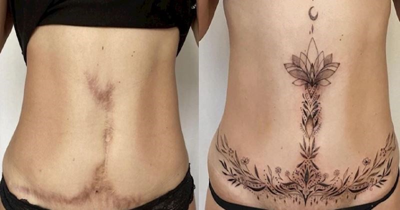 13 ljudi koji su svoje ožiljke pretvorili u mini remek-djela i sada konačno uživaju u svojoj koži