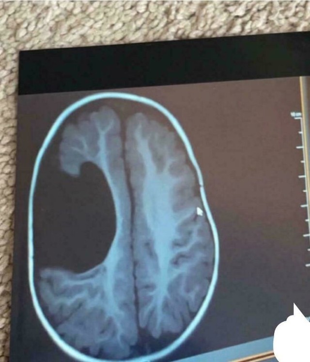 MRI snimka mozga koji nedostaje