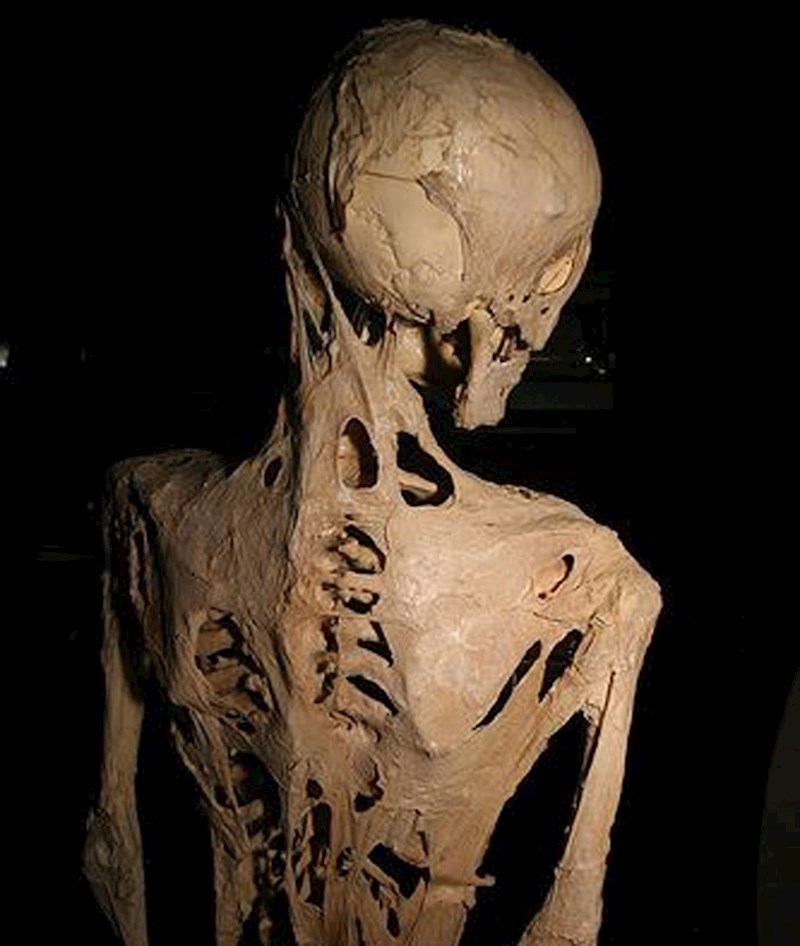Postoji poremećaj koji uzrokuje da vaše tijelo s vremenom zamijeni vaše mišićno tkivo kostima. Za one koji se pitaju, to se zove fibrodysplasia ossificans progressiva (FOP). I trenutno nema lijeka za nju