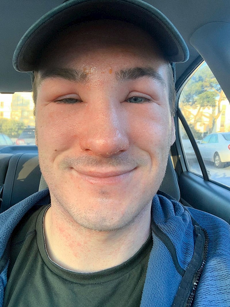 Otišao sam planinariti preko vikenda kako bih se ispuhao nakon ispita i zbog nečega sam dobio alergijsku reakciju. Pogodite tko danas ima prezentaciju?