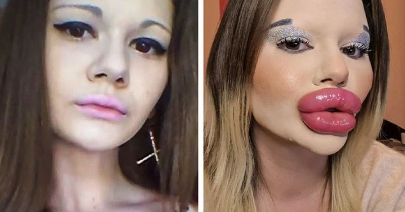 Andrea smatra da njezine sadašnje usne "nisu dovoljne".