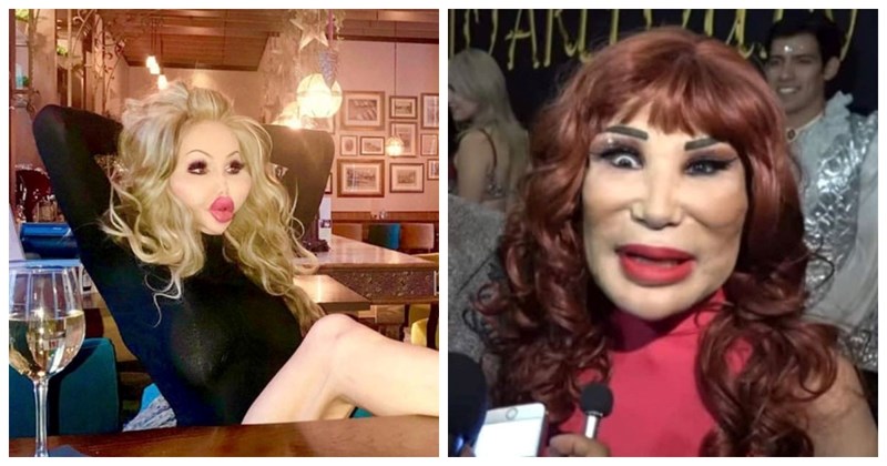 15 stravičnih prizora koje nam je priuštila plastična kirurgija