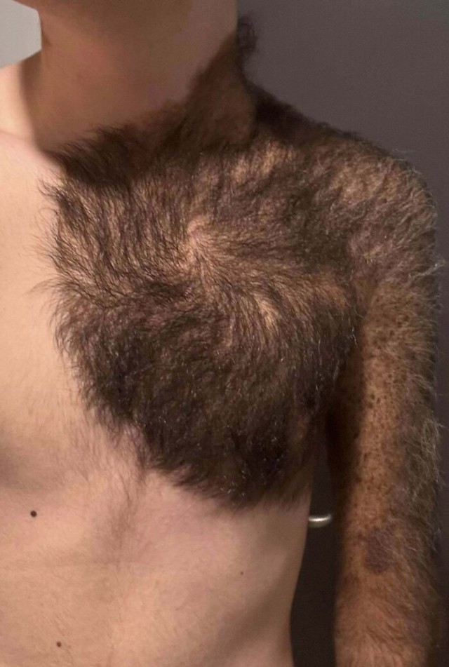 Divovski kongenitalni nevus