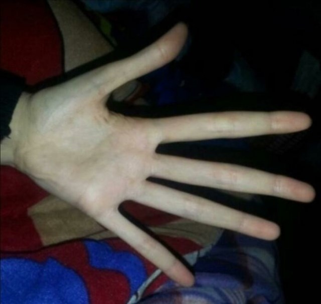 Ovako izgledaju dlanovi osobe s Marfanovim sindromom