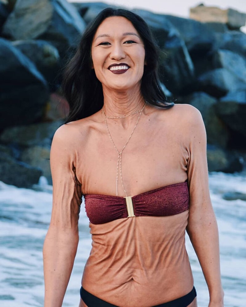 Ehlers-Danlosov sindrom