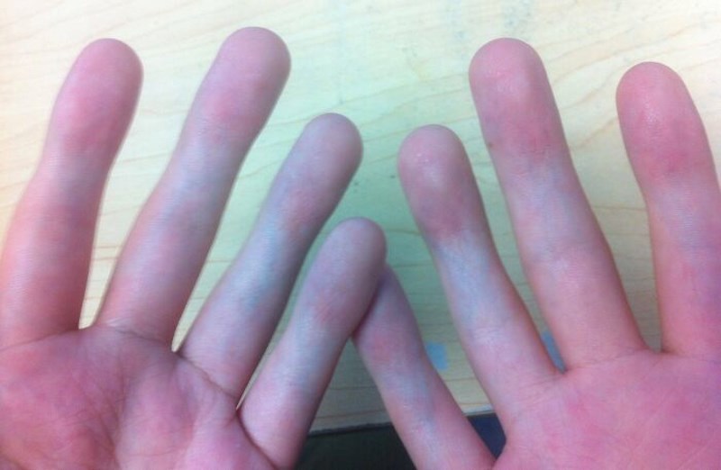 Ne mogu saviti nijedan prst, nemam zglobove u njima