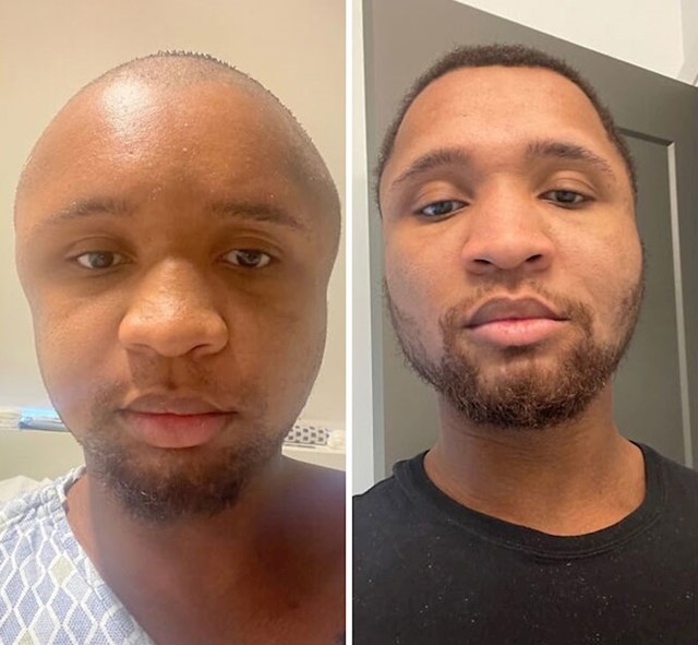 Dva mjeseca nakon operacije rekonstrukcije lica