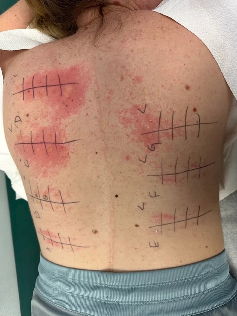 Alergije me baš vole