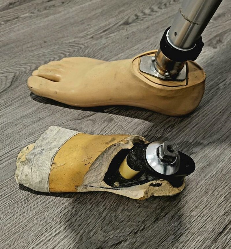 Moja nova proteza u odnosu na onu pomoću koje sam hodao dvije godine