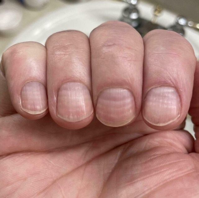 Linije na mojim noktima, po jedna za svaki ciklus kemoterapije