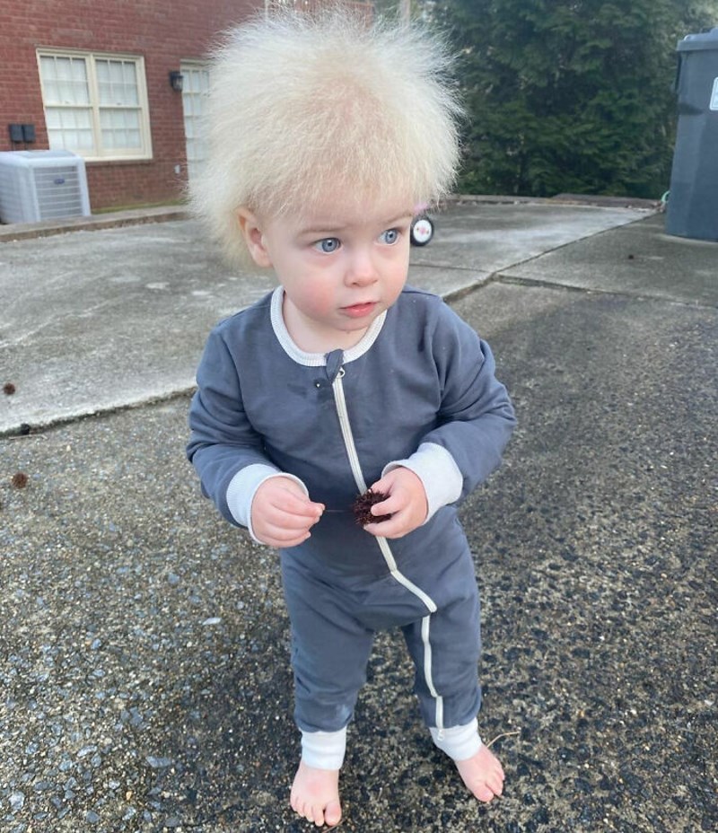 "Sindrom nepočešljane kose" je rijetko i bezopasno stanje koje nestaje oko puberteta