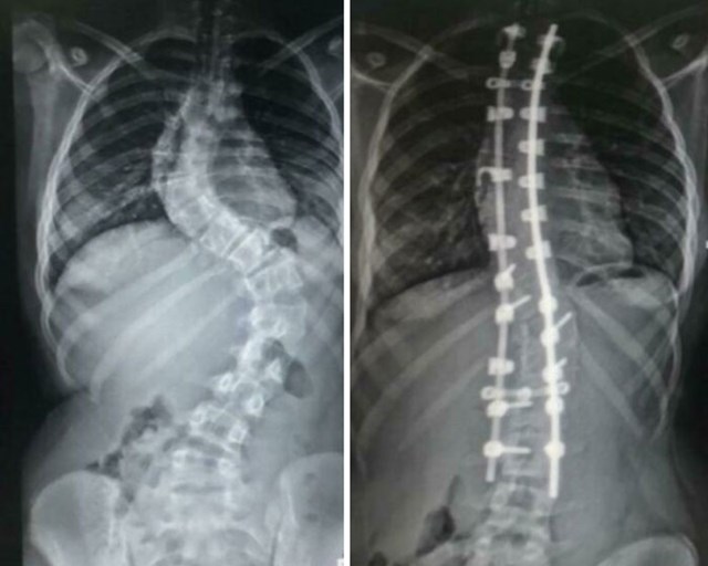 Moja kralježnica prije i poslije spinalne fuzije