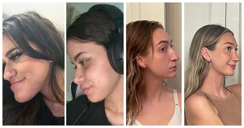 15 ljudi ohrabrilo se i podvrglo estetskim zahvatima, sada jedino žale što to nisu učinili ranije!