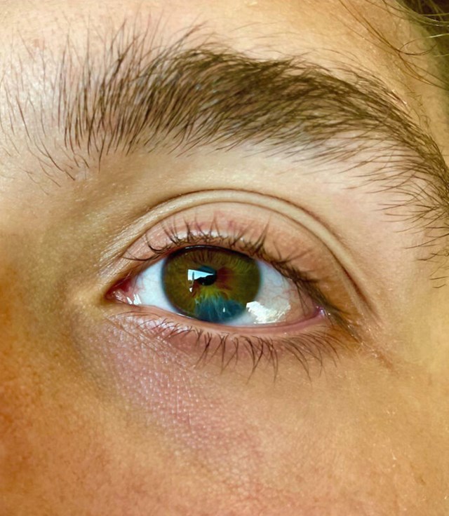 Moj brat je rođen sa smeđim očima i komadićem plave boje na šarenici jednog oka