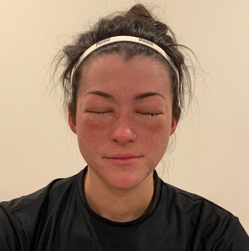 Razvila sam alergiju na banane