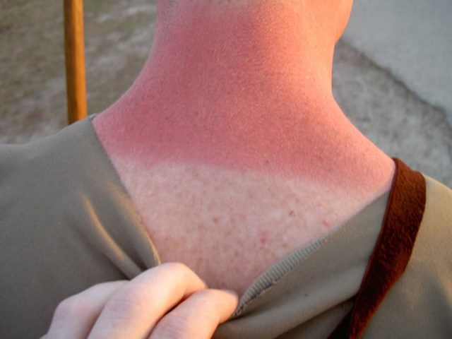 Bol koju osjećate od opeklina od sunca uzrokovana je time što se vaše stanice kože ubijaju prije nego što mutiraju u rak.