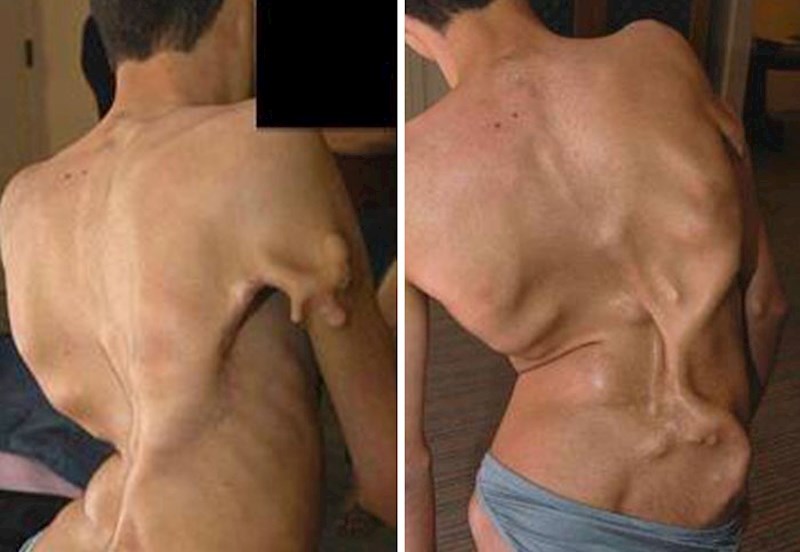 Postoji izuzetno rijetko stanje koje se zove "Sindrom čovjeka od kamena", ono uzrokuje da svako, i najmanje oštećenje tkiva ponovno preraste u kost, ukratko. Ljudi pogođeni ovom bolešću polako se pretvaraju u žive kipove kako stare