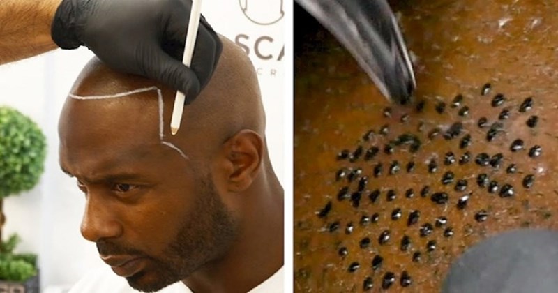 VIDEO Ćelavac je htio opet izgledati kao da ima kosu, ova tetovaža ga je na kraju oduševila