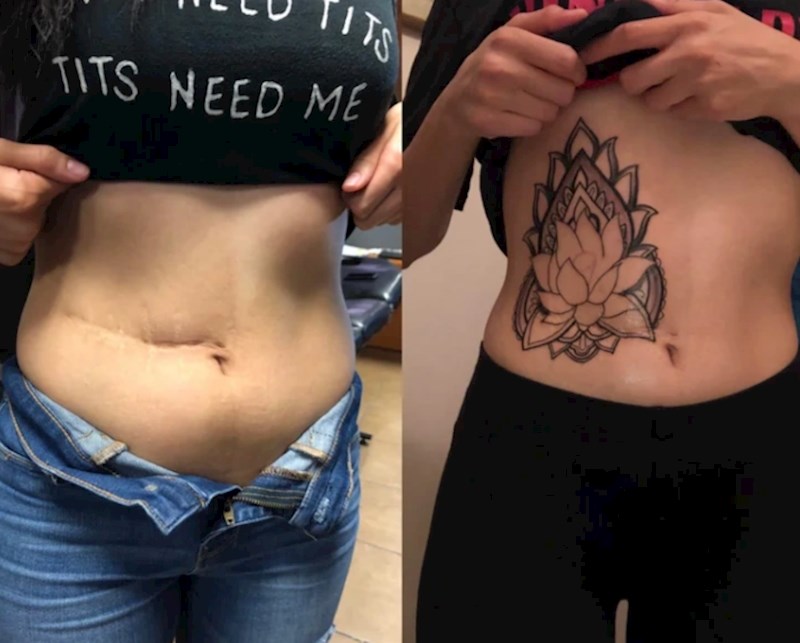 Nekada ružan ožiljak, a danas predivna tetovaža