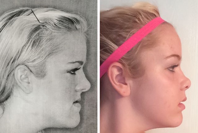 14. "Fotografija prije i fotografija poslije operacije čeljusti"