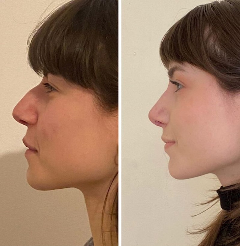 4. "Tri tjedna nakon operacije nosa i dalje se ne mogu nadiviti rezultatima!"