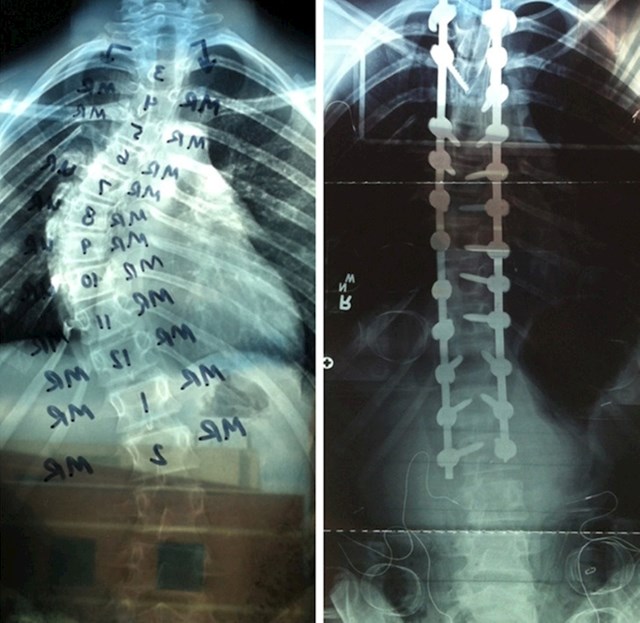 11. "Moj brat je nedavno išao na operaciju kralježnice. Evo slika od prije i poslije za usporedbu, nevjerojatna razlika!"