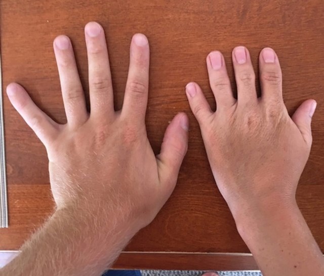 "Odlučili smo usporediti moju lijevu ruku i ruku moje sestre, pogledajte samo razliku"