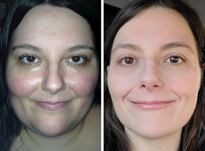 4. "Nisam mogla vjerovati koliko mi se koža popravila nakon što sam promijenila prehranu i smršavila"