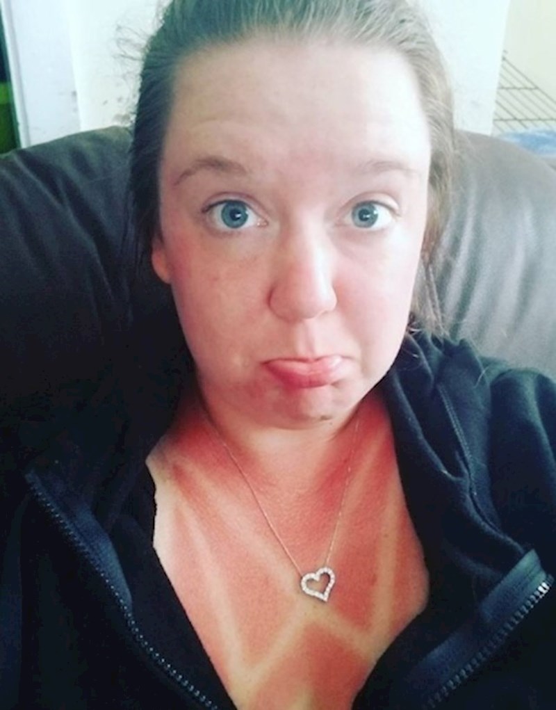 Žena koja očito više neće nositi ovakve majice po jakom suncu