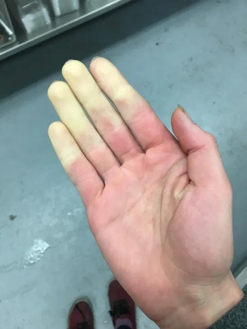 14. Bonus: U slučaju da ste se ikad pitali kako izgleda slaba cirkulacija, evo jedan primjer