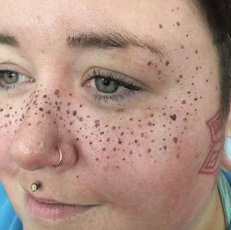 1. Dala si je tetovirati pjegice...