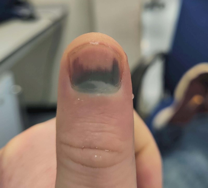 "Slučajno sam zalupio vratima po prstu..."