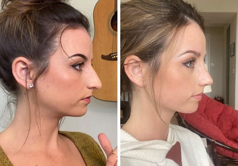 12. "Ovo sam ja dva tjedna nakon operacije nosa. Drago mi je što sam ga konačno odlučila operirati jer sam zbog njega bila užasno nesigurna"