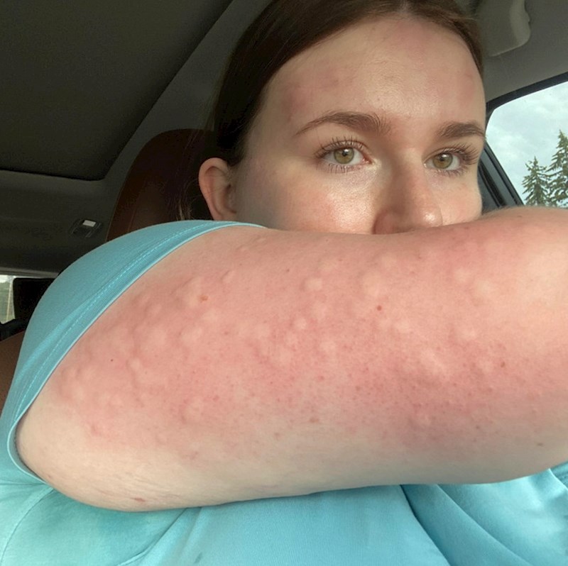 4. "Zaboravila sam se namazati kremom protiv uboda insekata. Tako mi i treba"